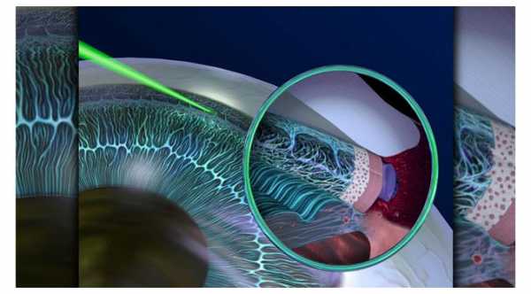 Glaucoma Laser Treatment. Selective Laser Trabeculoplasty