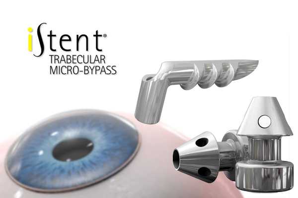Glaukos iStent (New Microinvasive Glaucoma Surgery)