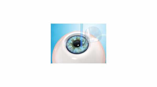 Glue Adhesive for Corneal Flap after Lasik Eye Surgery