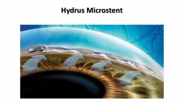 Hydrus Microstent for Glaucoma