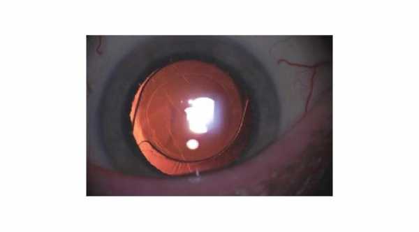 Hypotony After Cataract Eye Surgery © 2019 American Academy of Ophthalmology 