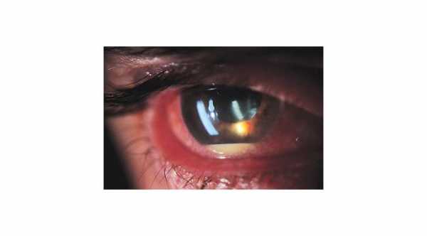 Iridocyclitis with hypopyon and red eye