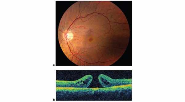 Treatment of Macular Hole. A- Macular Hole. Fundus Picture of the retina with macular hole. B- OCT for Macular hole.© 2019 American Academy of Ophthalmology 