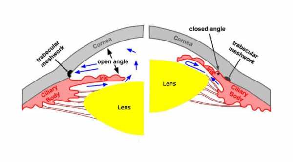 Narrow Angle Glaucoma