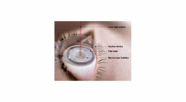 Ocular History for Lasik Eye Surgery
