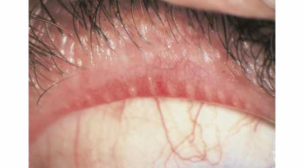 Posterior Blepharitis with Meibomian gland dysfunction© 2019 American Academy of Ophthalmology