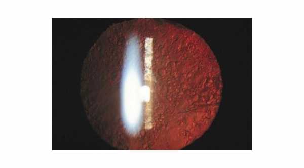 Posterior Capsular Opacification Or Secondary Cataract sue to opacification of the intraocular lens © 2019 American Academy of Ophthalmology