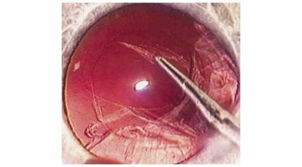 Posterior Capsule Rupture During Cataract Surgery