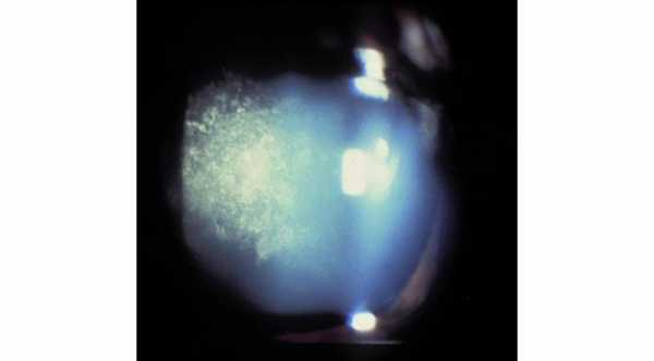 Posterior Subcapsular Cataract © 2019 American Academy of Ophthalmology 