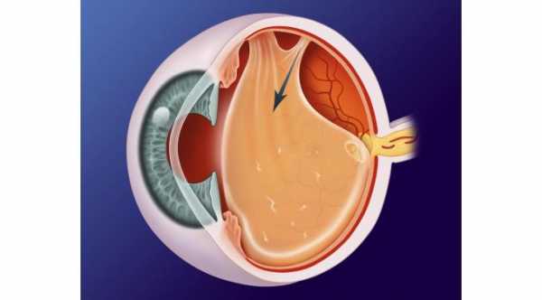 Posterior Vitreous Detachment . Vitreous is detached from the retina © 2019 American Academy of Ophthalmology