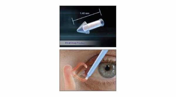 Prostaglandin Punctum Plugs for the treatment of glaucoma