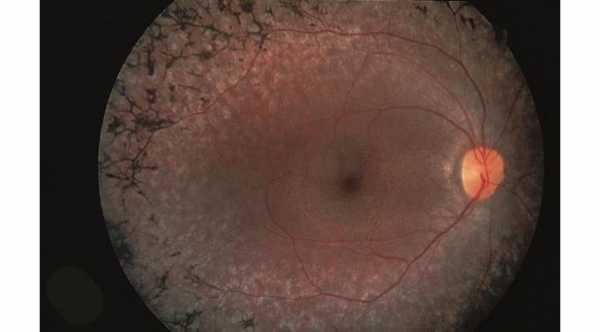 Retinitis Pigmentosa. Dark bone spicules with attenuation of retinal arteries © 2019 American Academy of Ophthalmology 