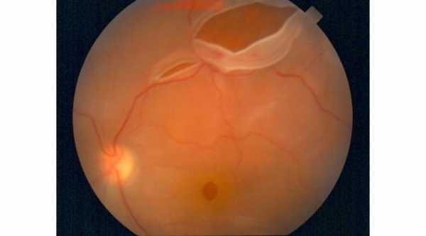 Rhegmatogenous Retinal Detachment due to large posterior tear near the superior arcade © 2019 American Academy of Ophthalmology