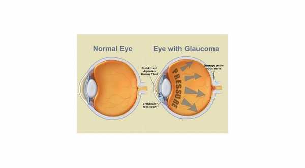 Secondary Glaucoma