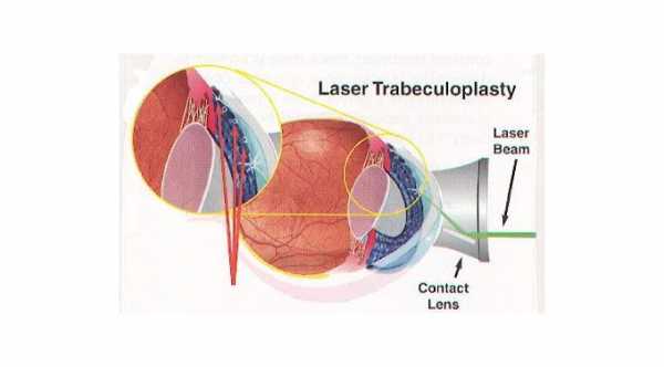 Selective Laser Trabeculoplasty in thin cornea