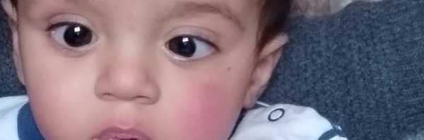 My son with strabismus-1