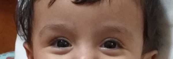 My son with strabismus-2