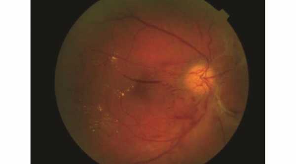 Symptoms of Diabetic Retinopathy. Proliferative diabetic retinopathy with hard exudates and fibrovascular membrane attached to the Optic Disc © 2019 American Academy of Ophthalmology