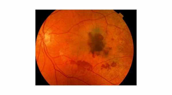 Wet Age Related Macular Degeneration with bleeding due to CNV © 2019 American Academy of Ophthalmology