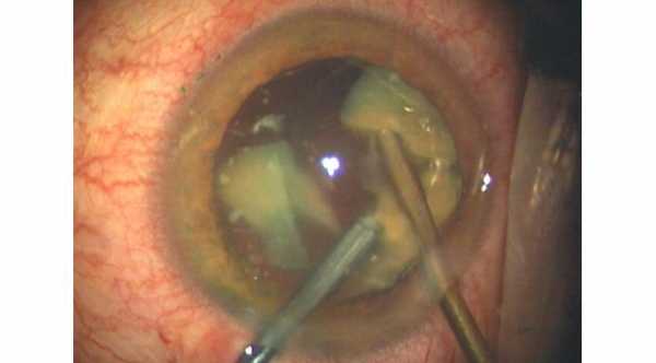 What To Expect After Cataract Surgery. Cataract Eye Surgery with Phaco-emulsification © 2019 American Academy of Ophthalmology