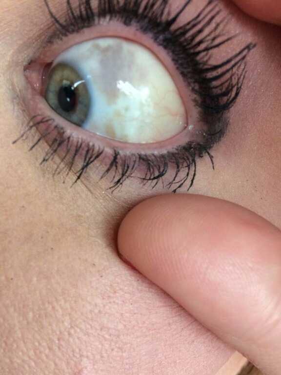 Black discoloration on my sclera