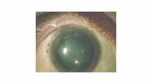 اصابات العين الكيميائية