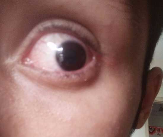 Eye Discharge-2
