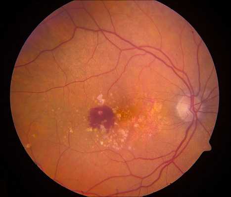 Integrin Peptide Therapy for Neovascular eye diseases