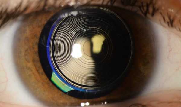Presbyopia Surgeries with Multifocal intraocular lens
