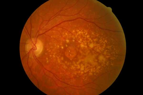 Signs of Age Related Macular Degeneration with drusens and atrophic changes