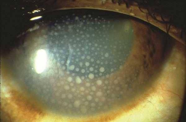 Symptoms of Uveitis. Anterior Uveitis. Large brownish cellular deposition in the interior part of the cornea due to severe anterior uveitis © 2019 American Academy of Ophthalmology