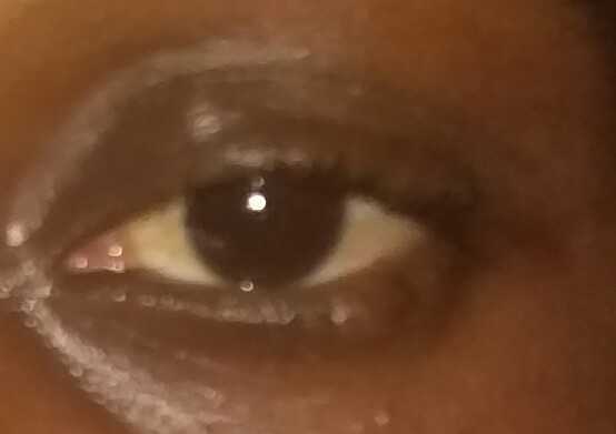 Why do I have lump on my eye