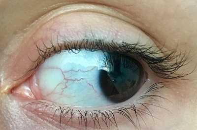 Yellowish area in the white part of my eyes-3