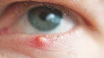 How to Prevent Stye formation