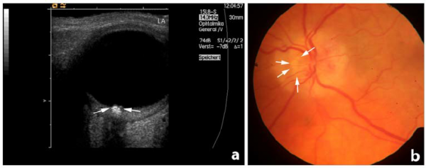 Optic disc drusens in normal fundus examination and B scan. It appears as calcified plate in B-Scan