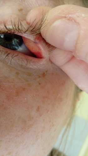 Small lump in eyelid