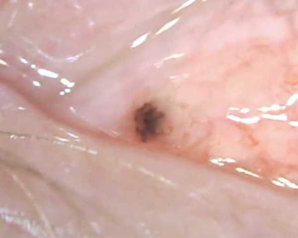 Black discoloration on caruncle