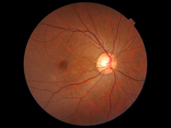 Second opinion for diabetic maculopathy 1