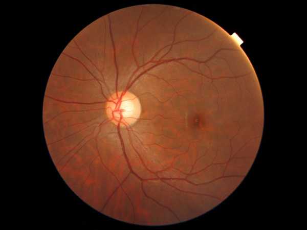 Second opinion for diabetic maculopathy 2