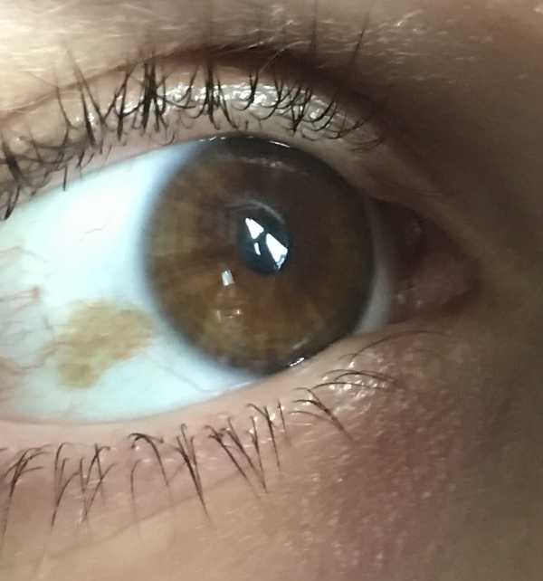 Brown spot in my eye