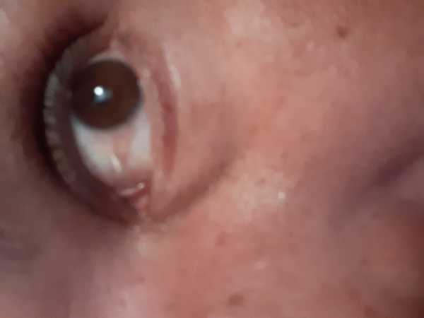 Flash eye burn over 7 days