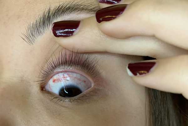 Bleeding in the eye above the iris