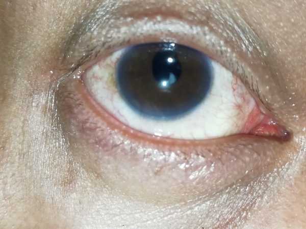 Blurry vision after cataract surgery