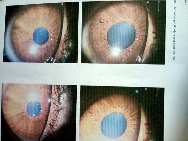 Left pupil dilation-3