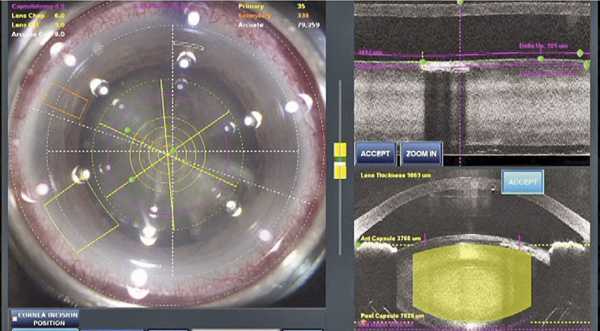 Femtosecond Laser Cataract Surgery