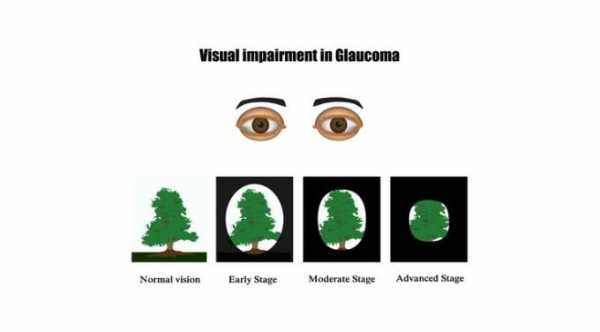 اعراض ارتفاع ضغط العين, اعراض الجلوكوما