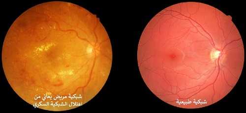 علاج اعتلال الشبكية السكري. شبكية العين الطبيعية مقارنة مغ شبكية العين لمريض السكري
