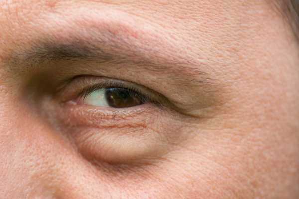 Causes of Puffy Eye