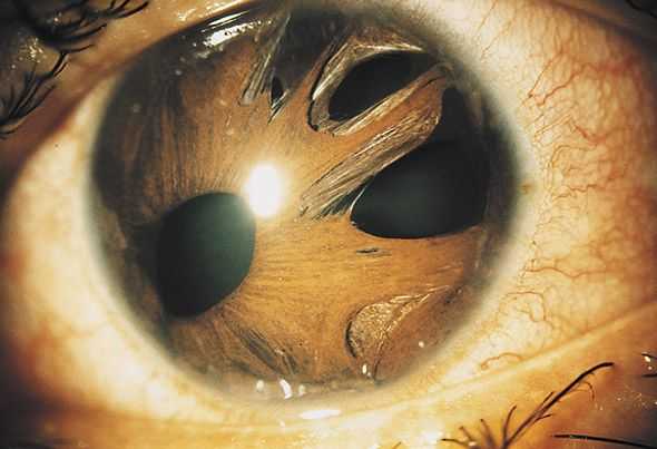 Iridocorneal Endothelial Syndrome. Essential iris atrophy with multiple holes ,polycoria