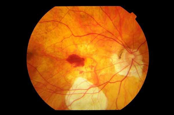 Myopic Macular Degeneration with atrophy of Retinal Pigment Epithelial and choroid in the macula with tilted disc and peripapillary atrophy with macular CNV and bleeding